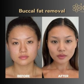 Before and after buccal fat removal at ID Clinic Bangkok, slimmer facial contour result