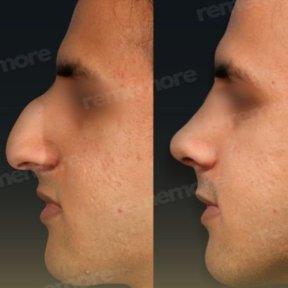 Vorher-nachher-Ergebnis der Revision-Rhinoplastik im Memorial Bahçelievler Hospital, Nasenkorrektur
