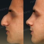 Vorher-nachher-Ergebnis der Revision-Rhinoplastik im Memorial Bahçelievler Hospital, Nasenkorrektur
