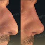 Vorher-nachher-Ergebnisse der Revision-Rhinoplastik im Memorial Bahçelievler Hospital, Nasenkorrektur