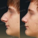 Vorher-nachher-Ergebnis der Revision-Rhinoplastik im Memorial Bahçelievler Hospital, verbesserte Nasenform