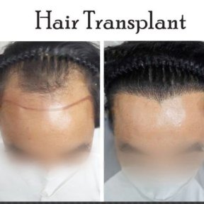 Before and after FUE hair transplant results at Asia Cosmetic Hospital, improved hairline