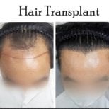 Before and after FUE hair transplant results at Asia Cosmetic Hospital, improved hairline