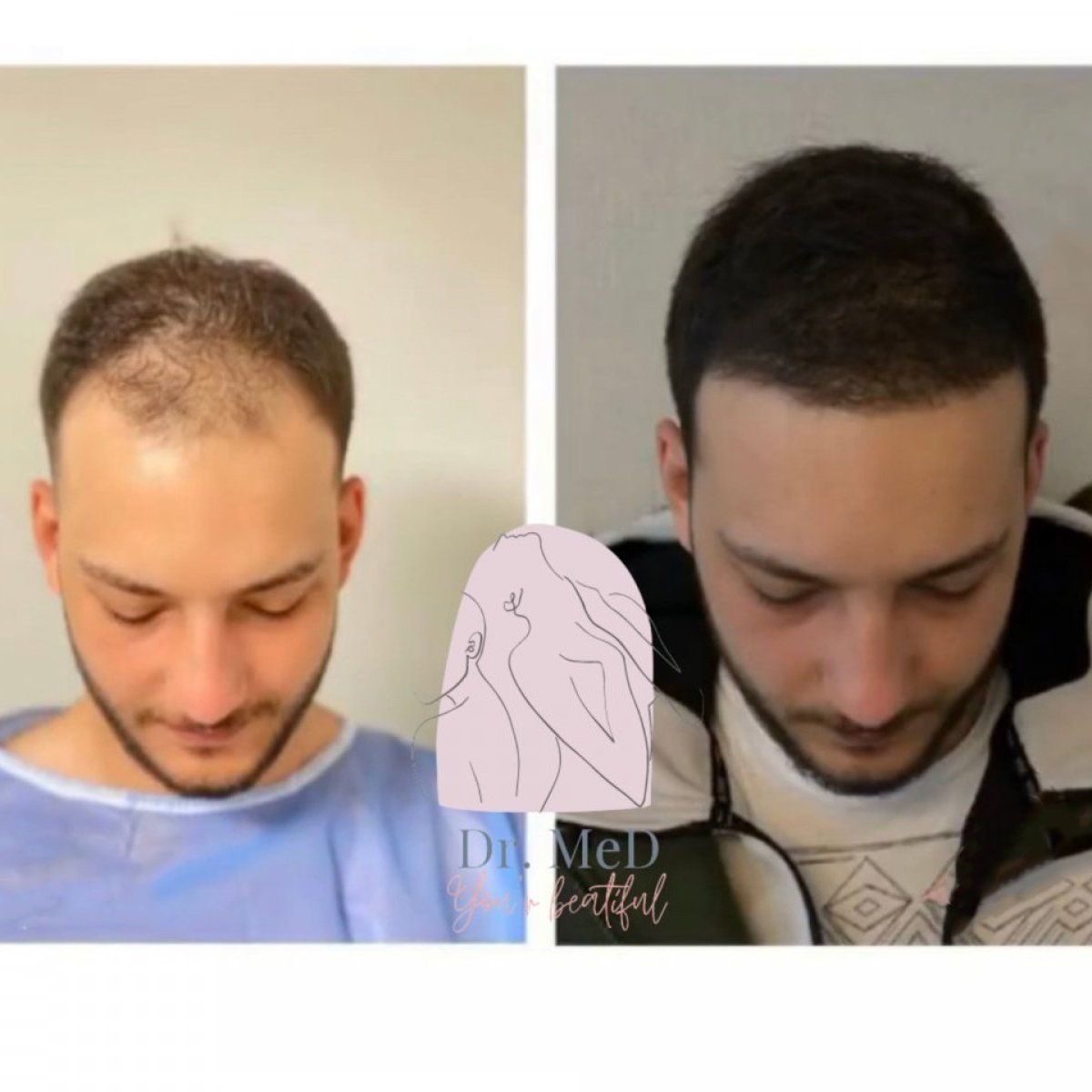 Vorher-nachher-Ergebnis FUE-Haartransplantation bei Dr. MED – volle Haarlinie