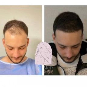 Resultado de trasplante capilar FUE antes y después en Dr. MED – línea capilar restaurada