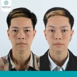 Before and after brow lift results at Rattinan Clinic, improved eyebrow position and symmetry