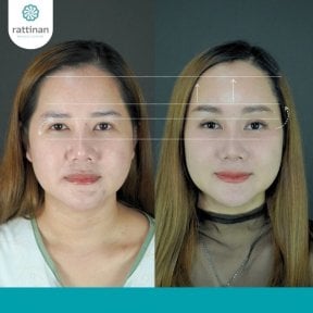 Before and after brow lift results at Rattinan Clinic, visible eyebrow and forehead lift