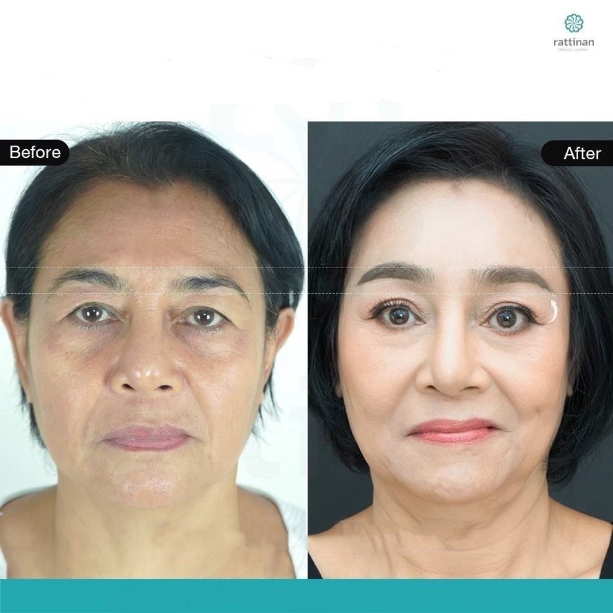Résultats avant/après lifting des sourcils à la Rattinan Clinic, rajeunissement visible