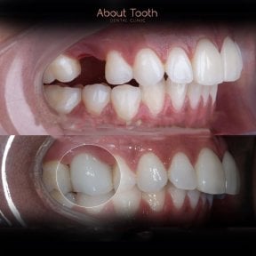 Resultados antes y después de implante dental en About Tooth Dental Clinic, diente restaurado