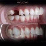 Resultados antes y después de implante dental en About Tooth Dental Clinic, diente restaurado