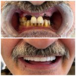 Before and after dental implant with crown results at My Nova Kusadasi Dental Clinic