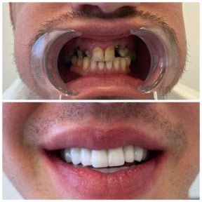 Before and after dental implant with crown results at My Nova Kusadasi Dental Clinic