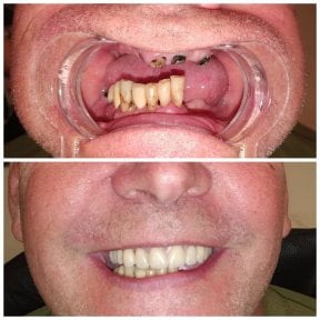 Before and after dental implant with crown results at My Nova Kusadasi Dental Clinic