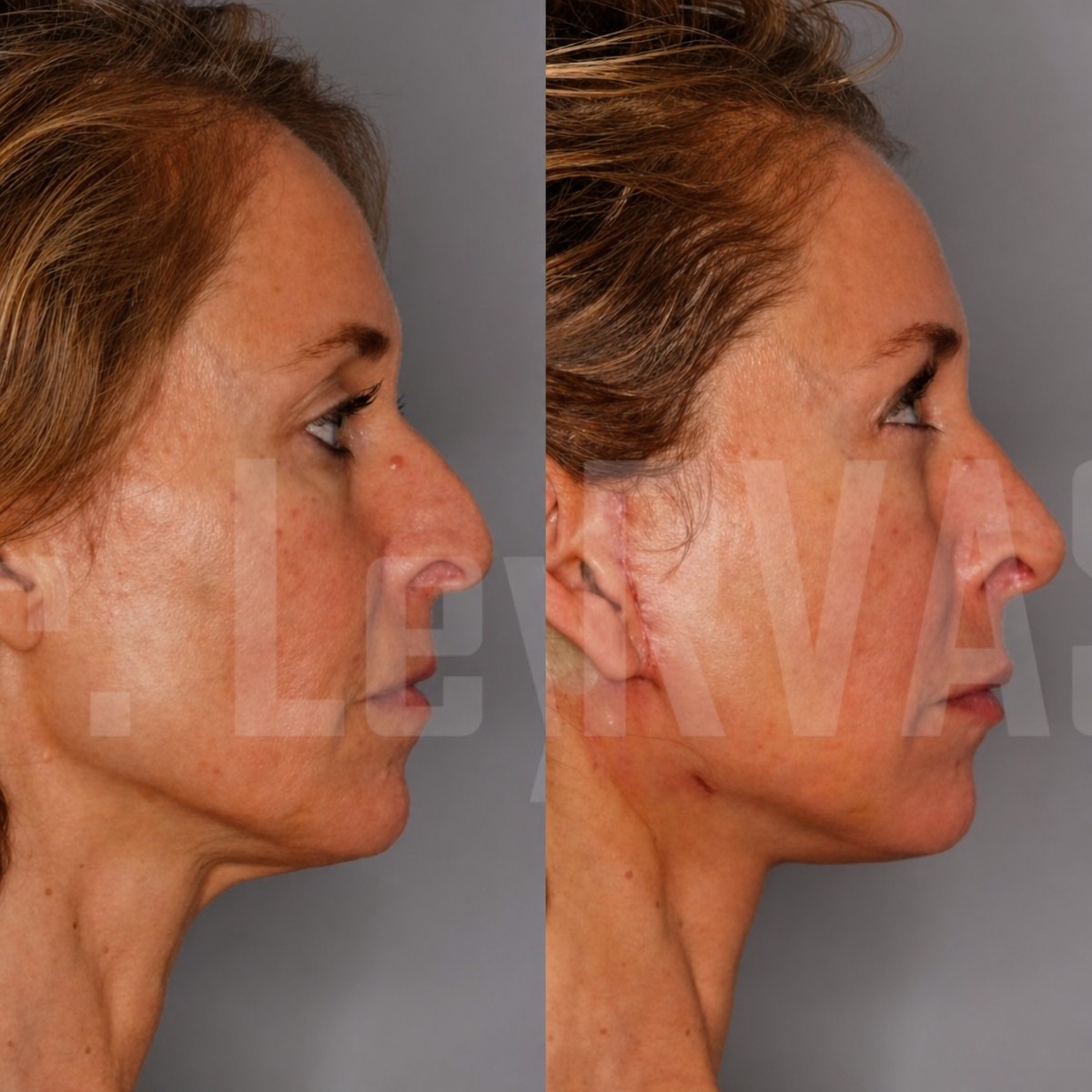 Resultados de lifting de cuello antes y después en Quartz Hospital, mejora del contorno