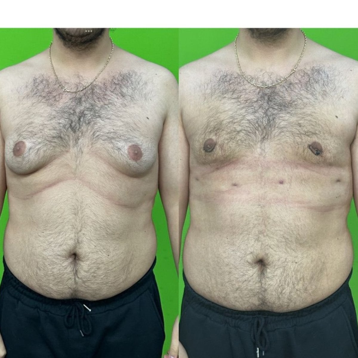 نتائج قبل وبعد جراحة التثدي في عيادة البروفيسور فوركان كارابكمز للتجميل