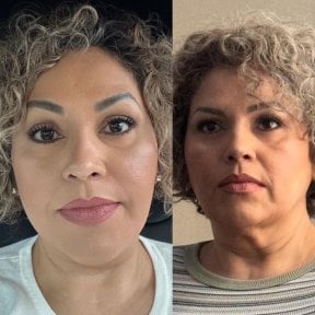 Результати до і після підтяжки обличчя в Marroquín & Sandoval Plastic Surgery Clinic, омолодження