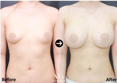 Vorher-nachher-Ergebnis Bruststraffung bei VG Plastic Surgery, sichtbare Konturverbesserung