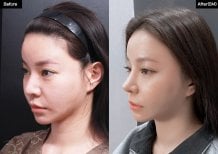 Результаты до и после закрытой ринопластики в VG Plastic Surgery, улучшенный профиль носа