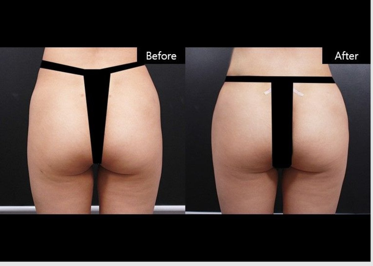 Resultados antes y después de Brazilian Butt Lift en VG Plastic Surgery, contorno mejorado