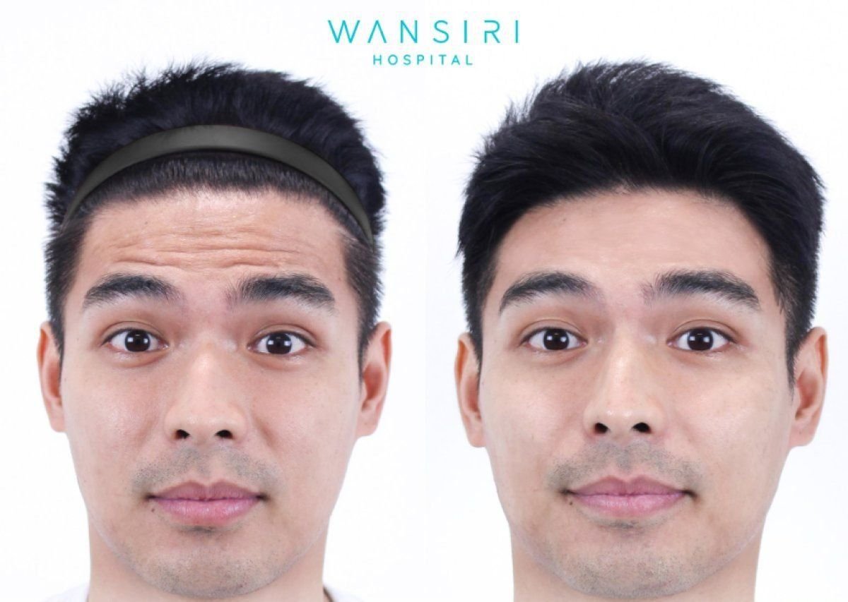 Avant et après injections de Botox à Wansiri Hospital, réduction visible des rides du front