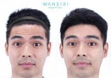 До і після ін'єкцій ботоксу у Wansiri Hospital, помітне зменшення зморшок на лобі