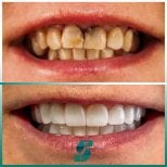 Before and after All-on-4 dental implants result at Soraca Med – full smile restoration
