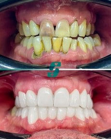 Before and after All-on-4 dental implants result at Soraca Med, full smile restoration