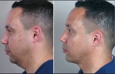 Before and after laser skin resurfacing at ID Clinic Bangkok, improved jawline and skin texture result