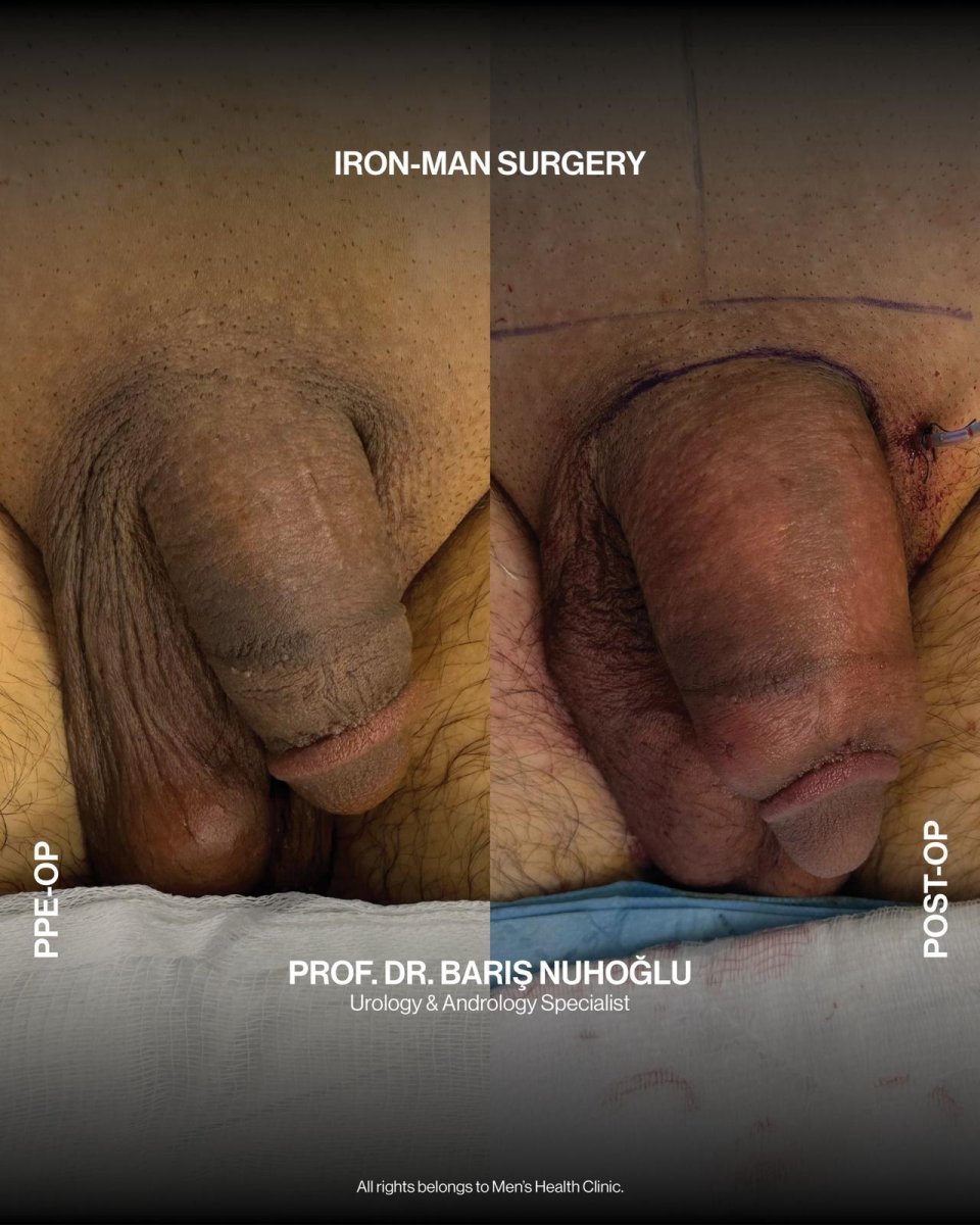 Resultados antes y después de aumento de pene en Men's Health Clinics con mayor tamaño visible