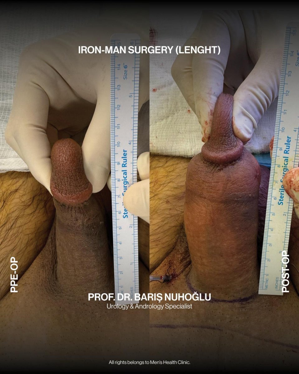 Resultados antes y después de alargamiento de pene en Men's Health Clinics, aumento visible