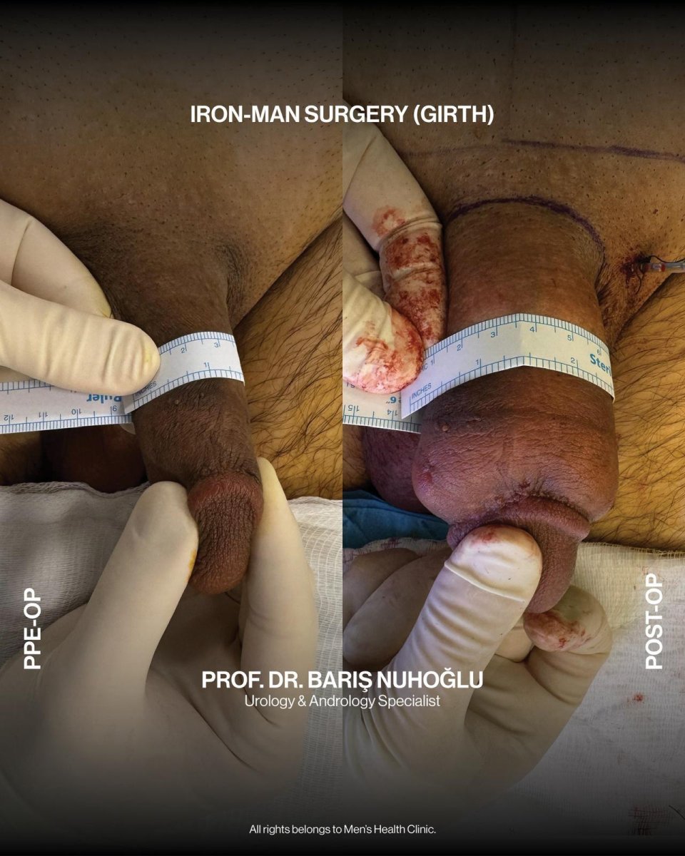 Resultados de aumento de grosor de pene antes y después en Men's Health Clinics con cirugía Iron-Man