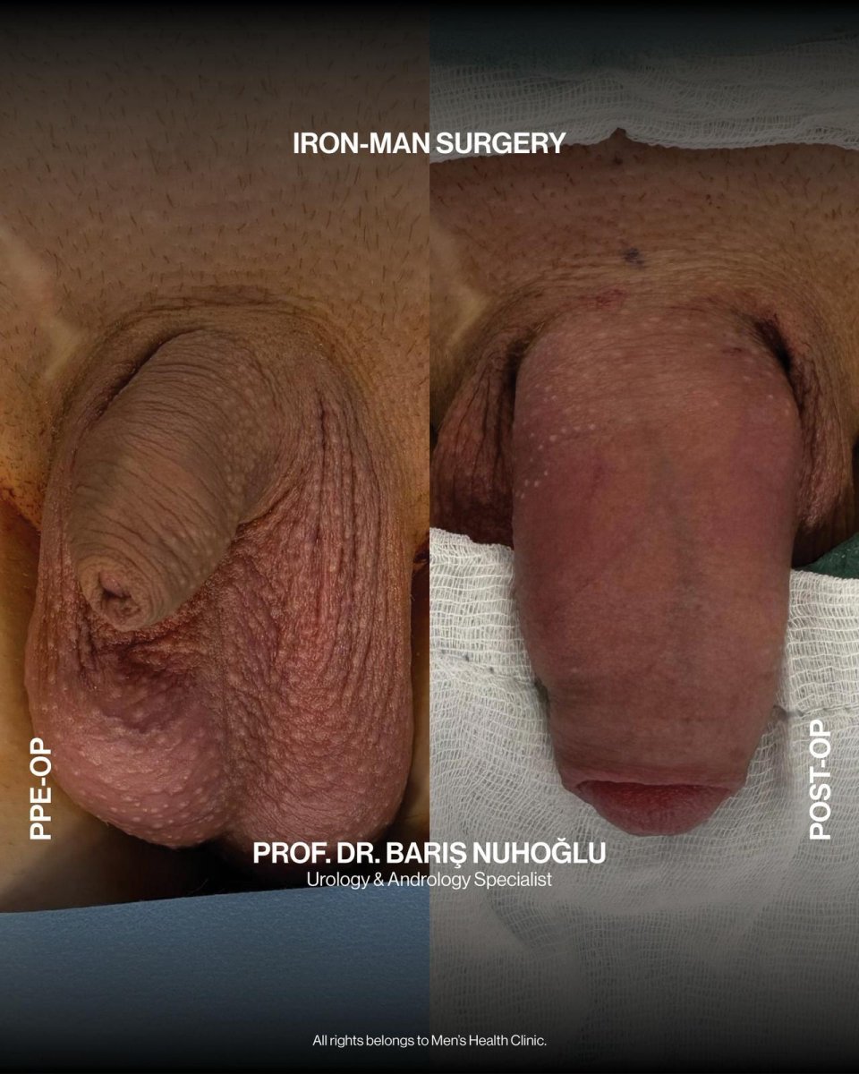 Resultados antes y después de aumento de pene en Men's Health Clinics con cirugía Iron-Man
