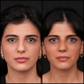 Vorher-nachher-Ergebnis der Nasenkorrektur in Medipol Acibadem District Hospital, Rhinoplastik