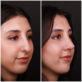 Vorher-nachher-Rhinoplastik-Ergebnisse bei Medipol Acibadem District Hospital, Nasenkorrektur