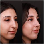 Vorher-nachher-Rhinoplastik-Ergebnisse bei Medipol Acibadem District Hospital, Nasenkorrektur