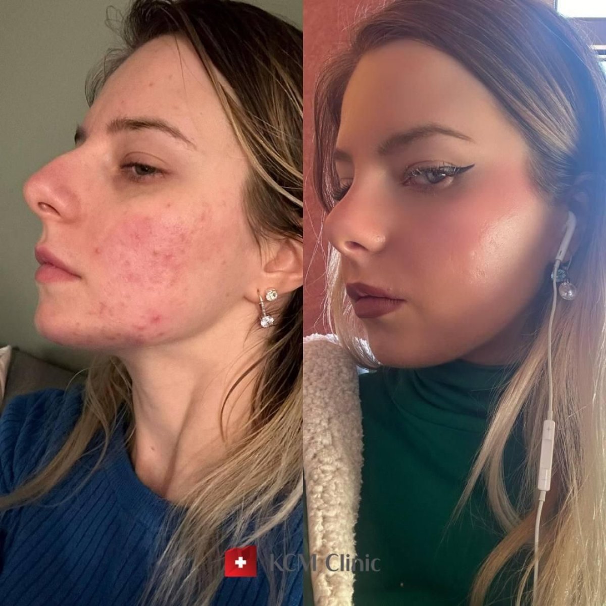 Resultados antes y después del tratamiento del acné en KCM Clinic: piel facial más clara
