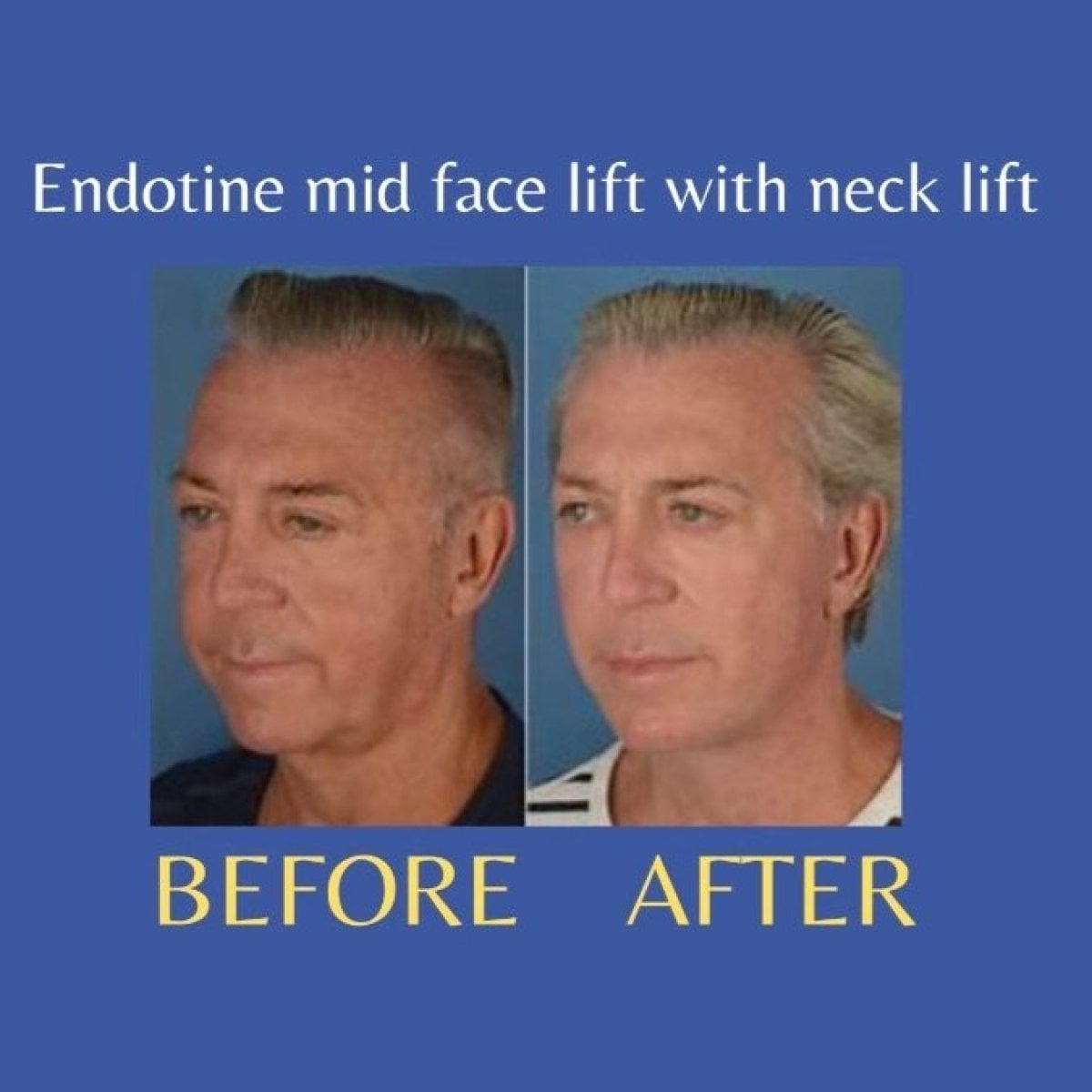 Resultados antes y después de lifting endoscópico facial y de cuello en ID Clinic Bangkok