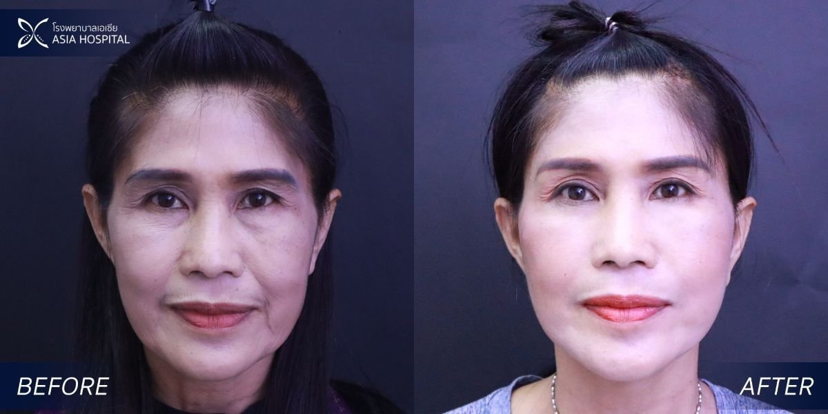 نتائج شد الوجه المصغر قبل وبعد في Asia Cosmetic Hospital، تجديد شباب الوجه
