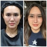 Resultados de rejuvenecimiento facial con terapia de células madre en Wansiri Hospital