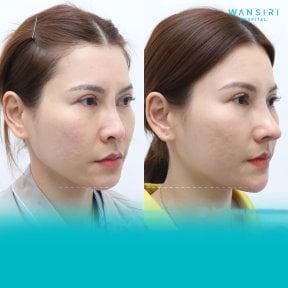 Before and after chin implant results at Wansiri Hospital, enhanced chin contour visible