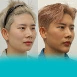 Before and after chin implant results at Wansiri Hospital, enhanced chin contour visible