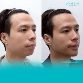 Before and after chin implant at Wansiri Hospital, enhanced chin contour visible result