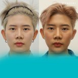 Before and after chin implant results at Wansiri Hospital, enhanced chin contour visible