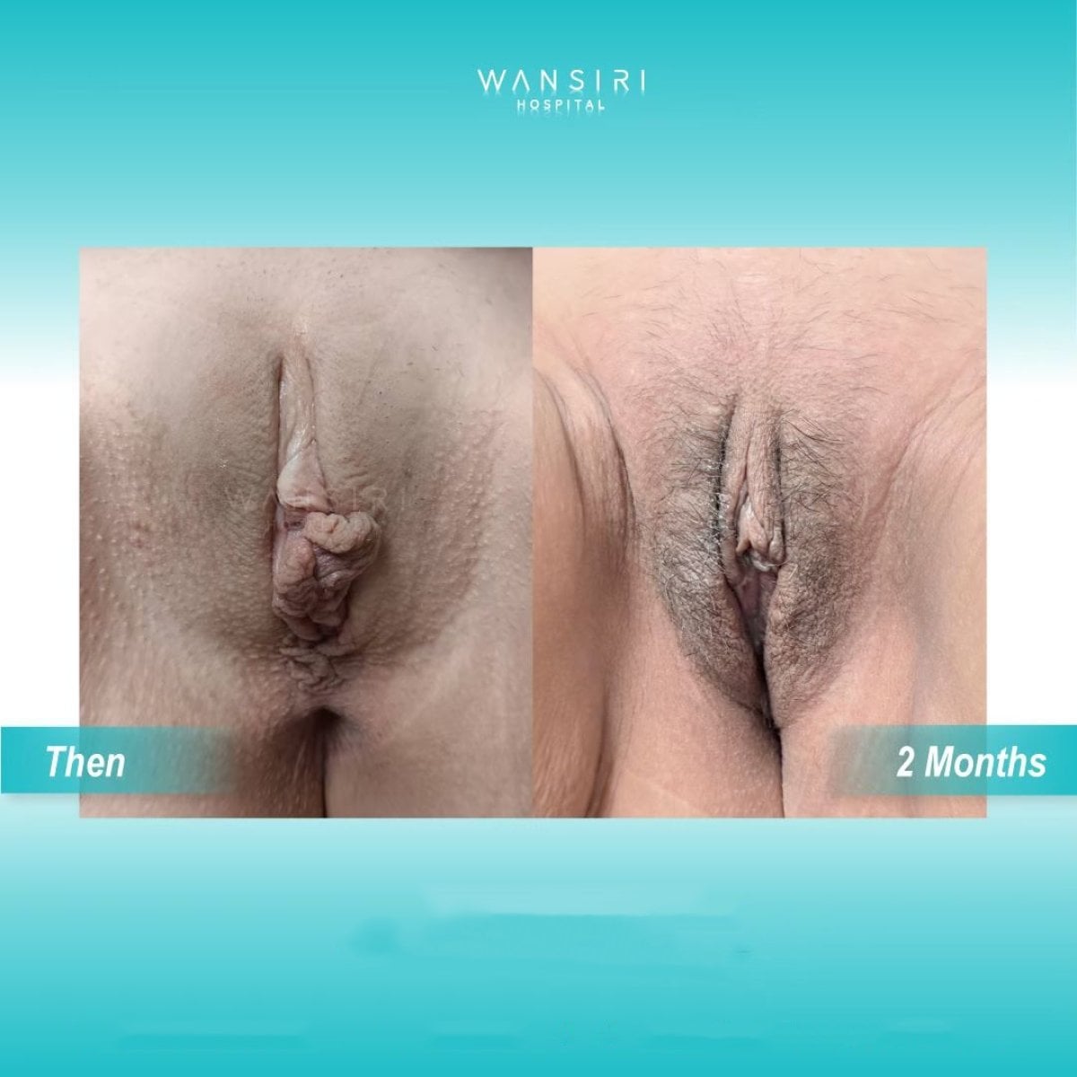 Resultados de antes y después de labioplastia en Wansiri Hospital, mejora en 2 meses