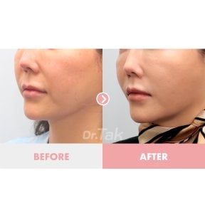 Facelift Vorher-nachher-Ergebnis bei Dr. Tak Plastic Surgery – verbesserte Gesichtskontur