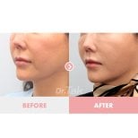 Facelift Vorher-nachher-Ergebnis bei Dr. Tak Plastic Surgery – verbesserte Gesichtskontur
