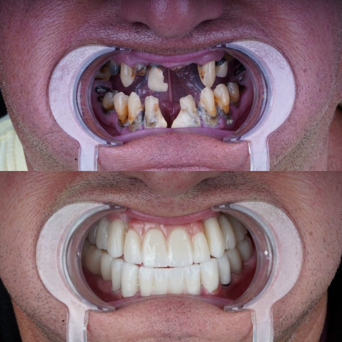 Before and after Hollywood Smile dental restoration at Dent48 Oral and Dental Health Polyclinics