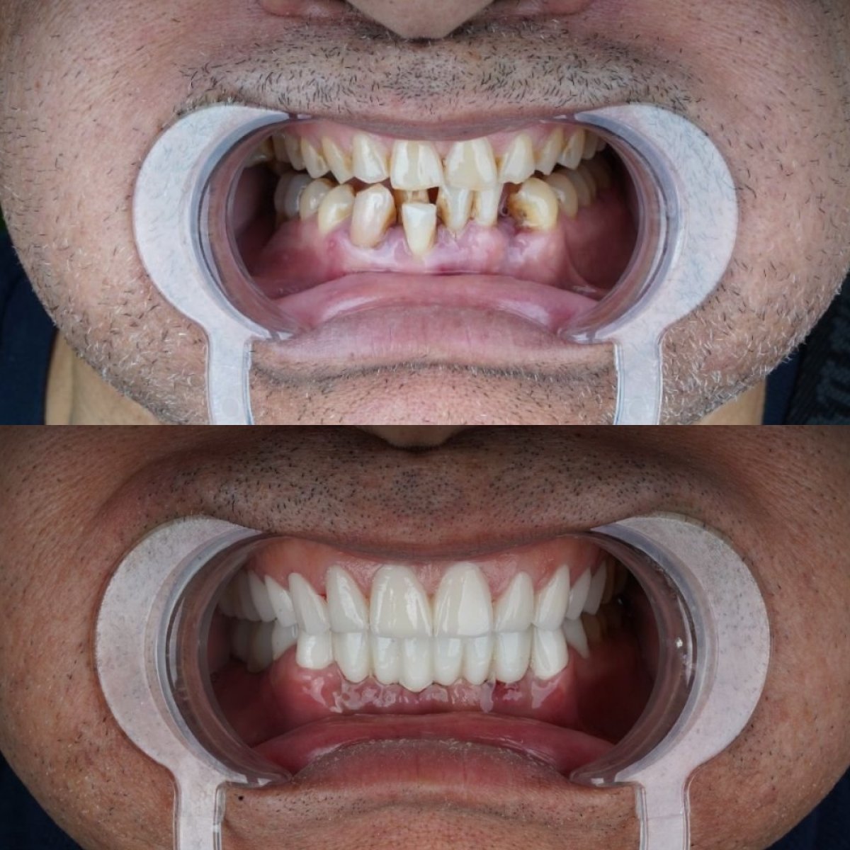 Before and after Hollywood Smile results at Dent48 Oral and Dental Health Polyclinics, smile makeover