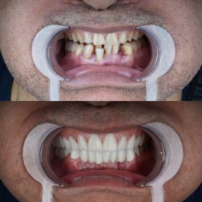Vorher-nachher-Ergebnis Hollywood Smile bei Dent48 Oral and Dental Health Polyclinics, neues Lächeln