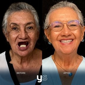 Resultados de implantes dentales antes y después en YeahSmile – sonrisa restaurada